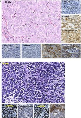 Somatostatin Receptors in Merkel-Cell Carcinoma: A Therapeutic Opportunity Using Somatostatin Analog Alone or in Association With Checkpoint Inhibitors Immunotherapy. A Case Report